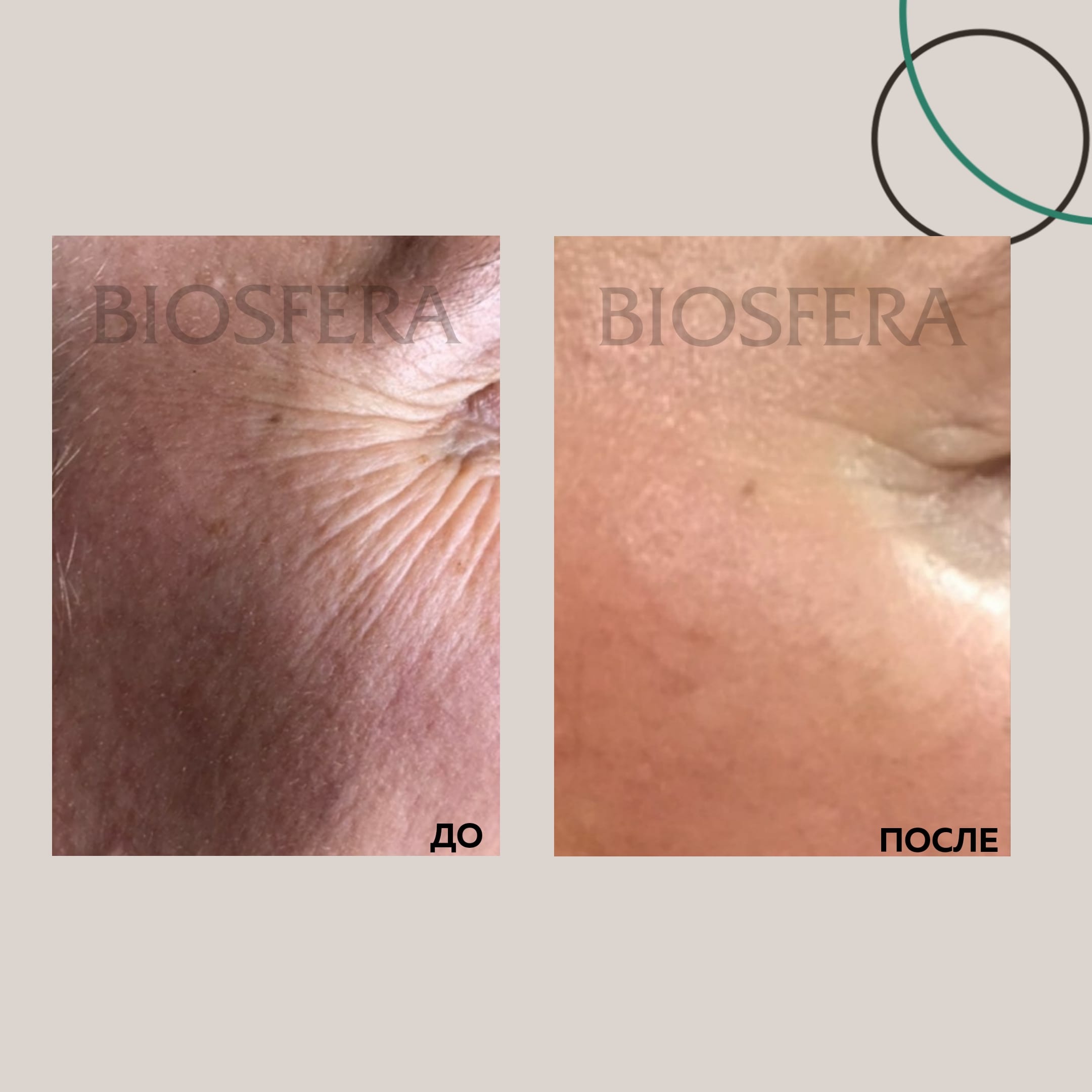 SMAS-лифтинга Ultraformer