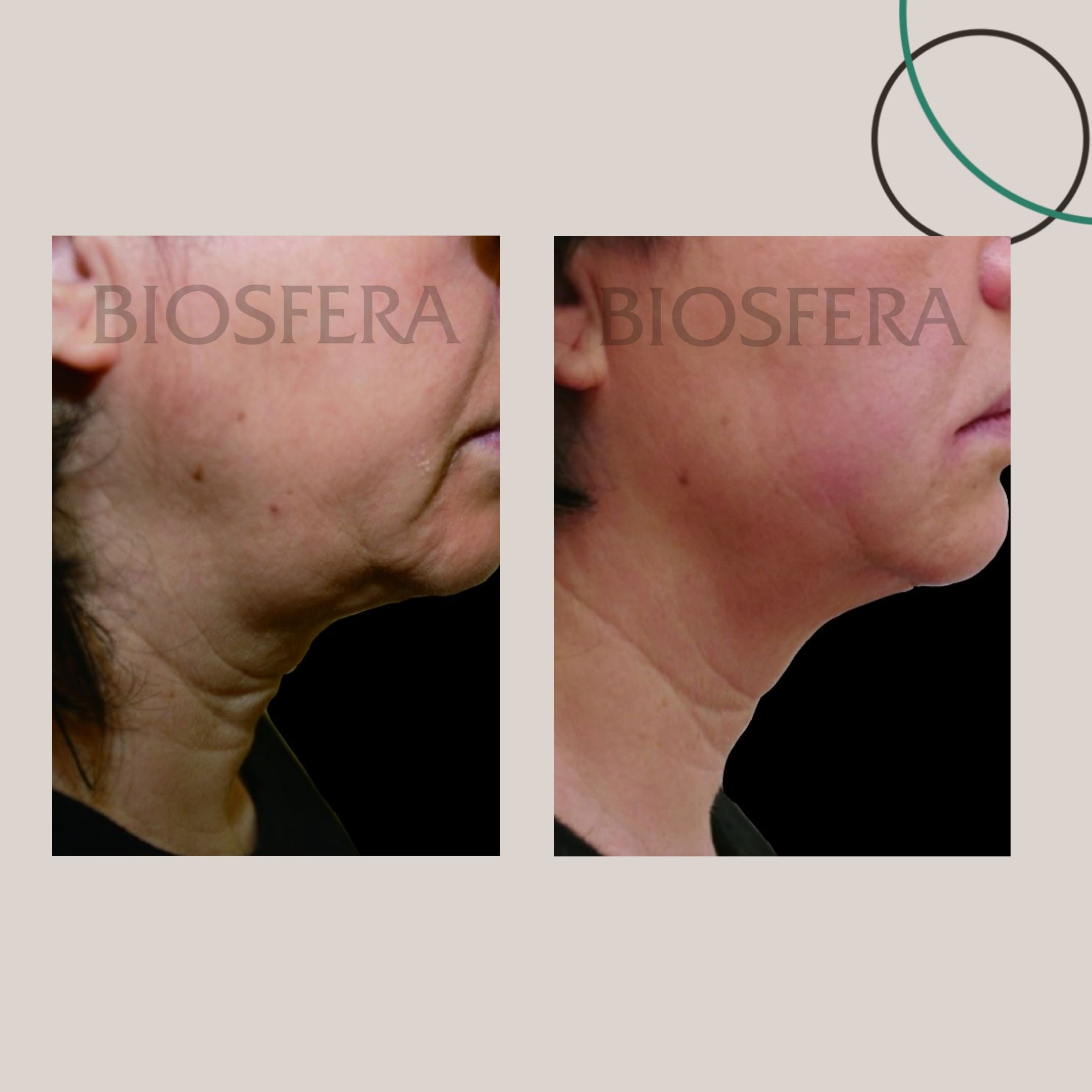 SMAS-лифтинга Ultraformer