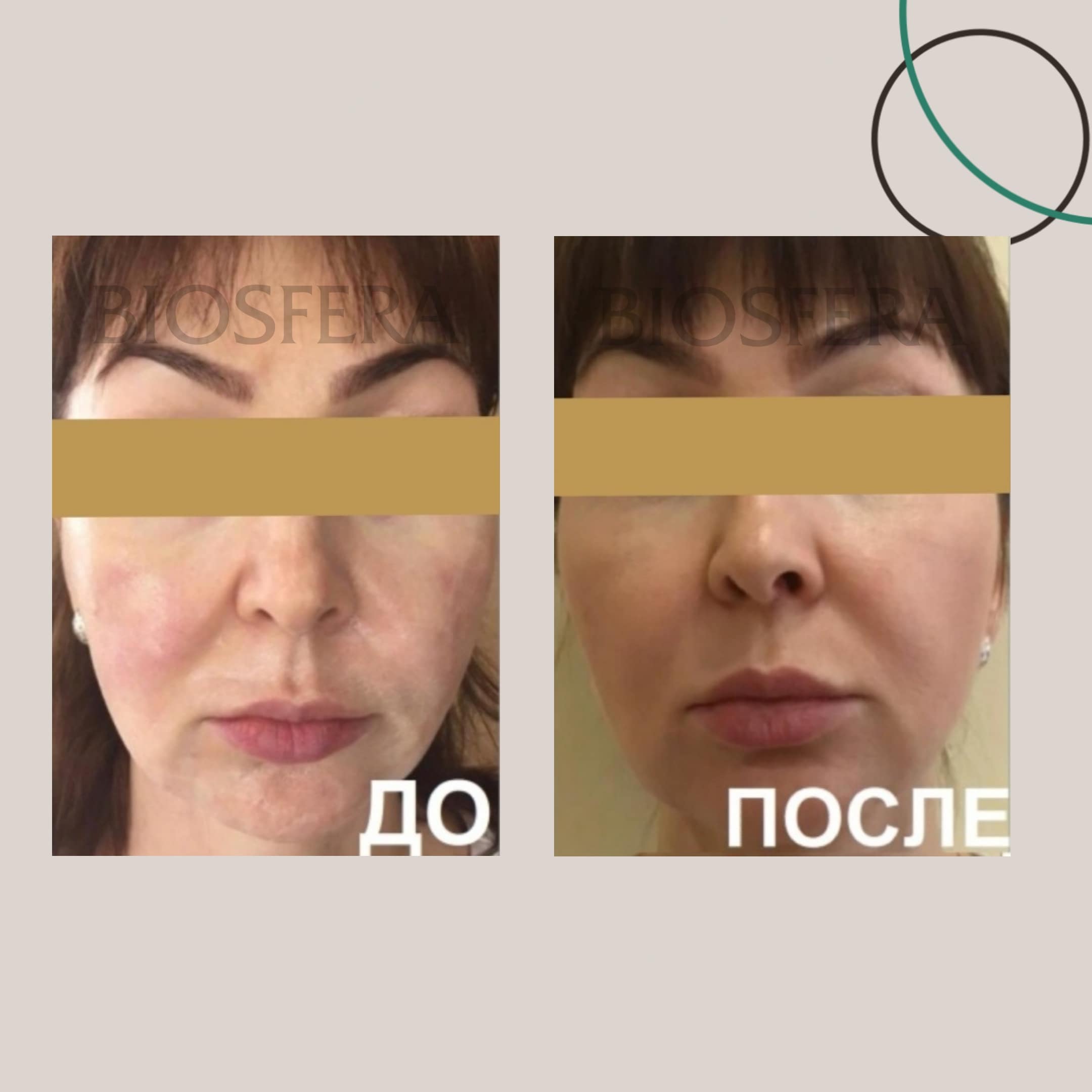 SMAS-лифтинга Ultraformer