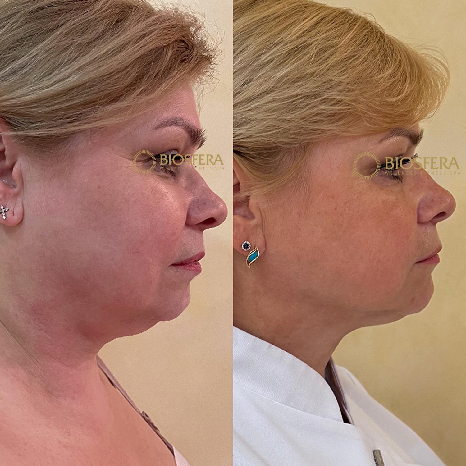 Как вам результат омоложения (до и спустя 8 месяцев)? от MediSPA центр BIOSFERA Как вам результат омоложения (до и спустя 8 месяцев)?